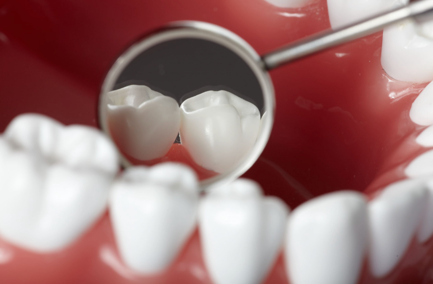 caries oculta entre dos dientes
