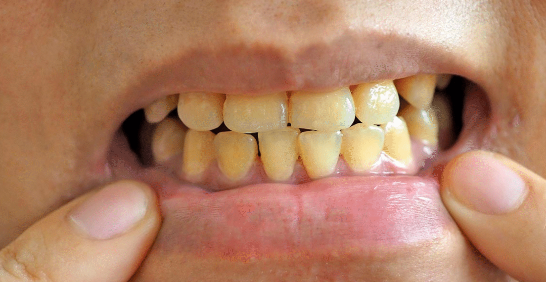 ¿Por qué tengo los dientes amarillos si me los cepillo todos los días?